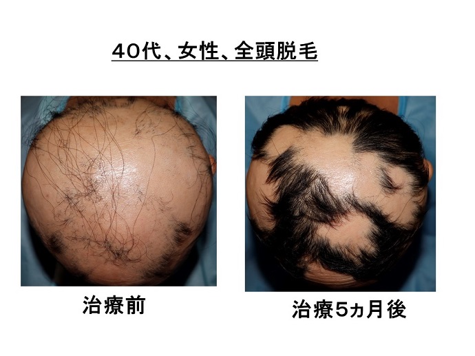 円形脱毛症　病院